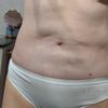 Solchi addome dopo lipofilling