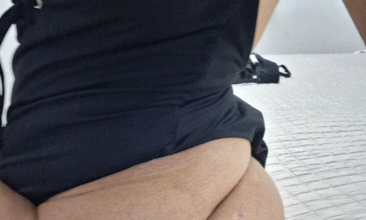 45 giorni post liposuzione glutei svuotati - 83050