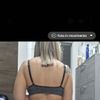 45 giorni post liposuzione glutei svuotati