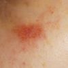Trattamento angioma stellato con laser vascolare- peggioramento
