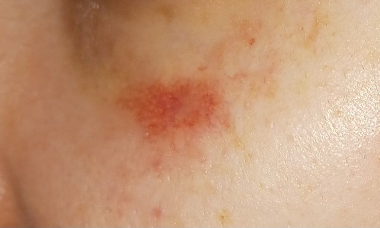 Trattamento angioma stellato con laser vascolare- peggioramento - 83125