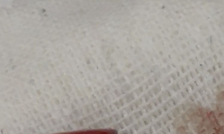 Buco dovuto a rimozione neo con laser su zigomo - 83140