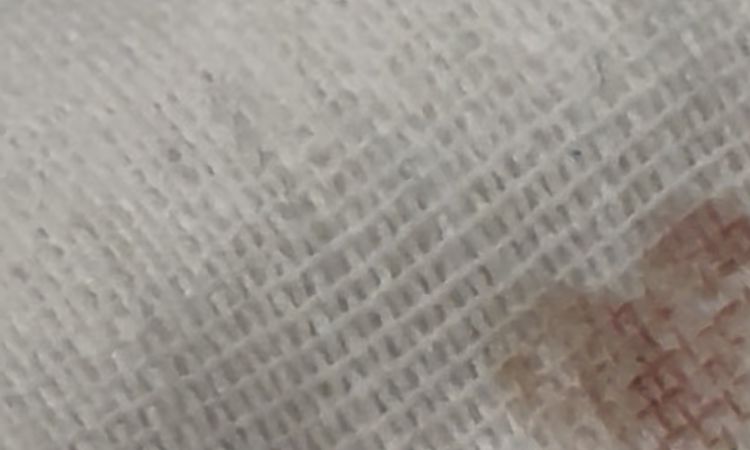 Buco dovuto a rimozione neo con laser su zigomo - 83141