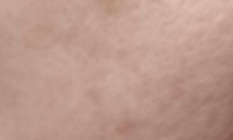 Macchia sul viso che non passa - 83144