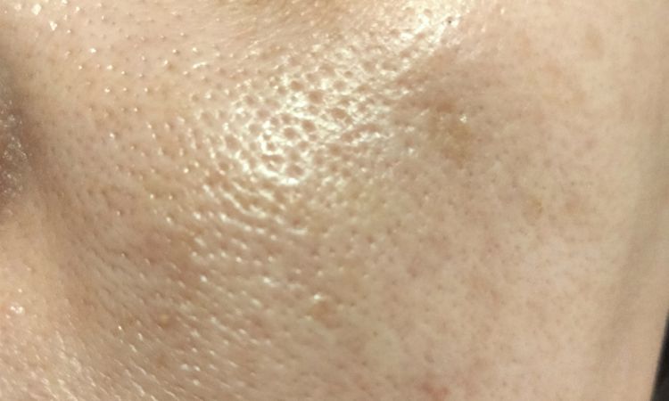 Macchia sul viso che non passa - 83145