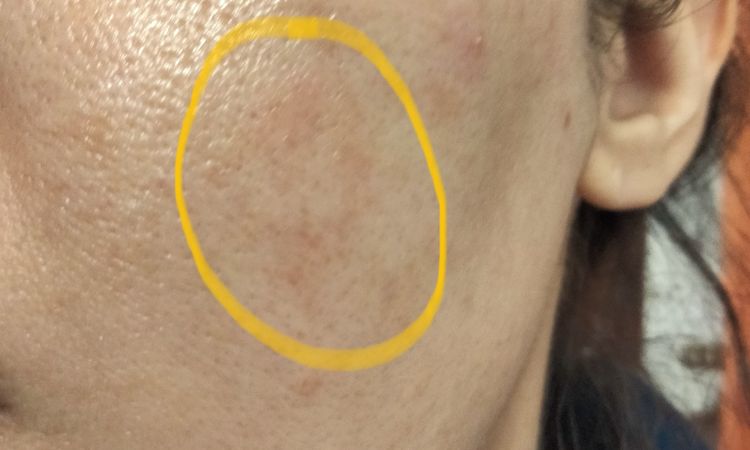 Macchia sul viso che non passa - 83146