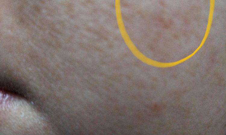 Macchia sul viso che non passa - 83147