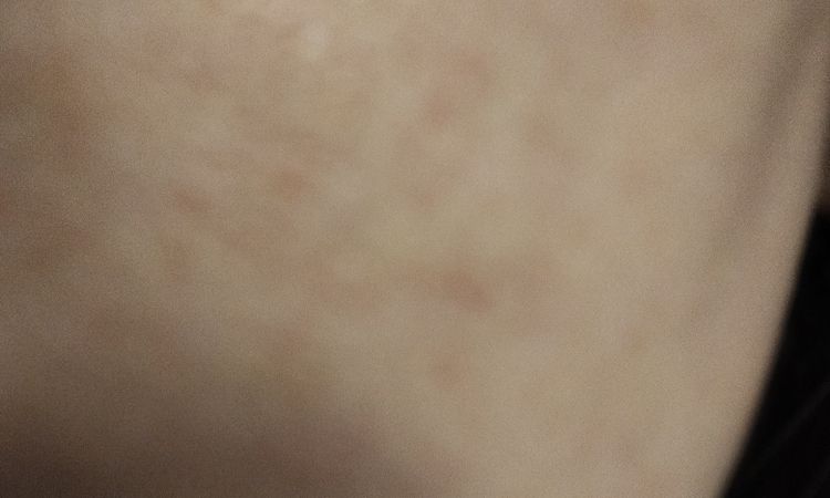 Macchia sul viso che non passa - 83148