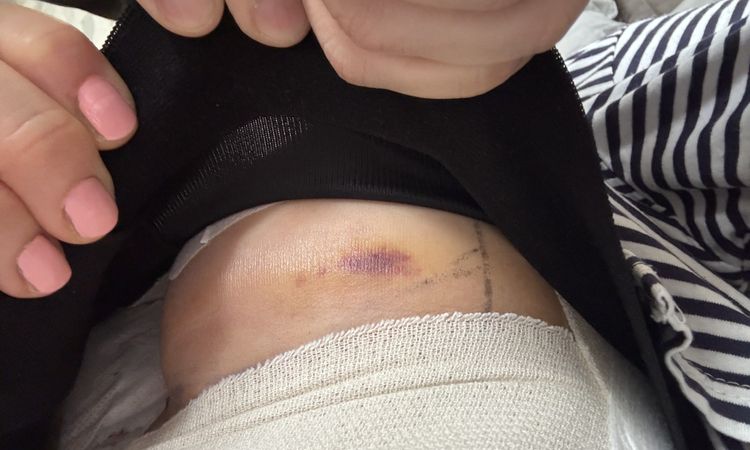 Postoperatorio mastopessi - 83158