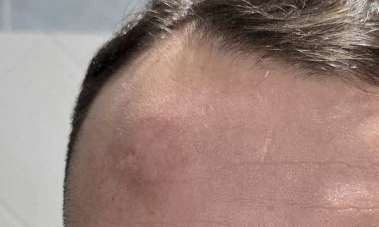 Gonfiore fronte post rimozione lipoma - 83179