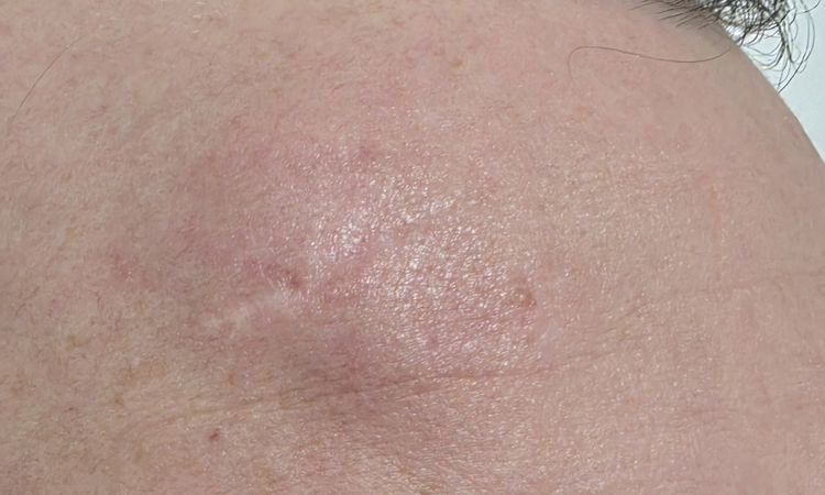 Gonfiore fronte post rimozione lipoma - 83180
