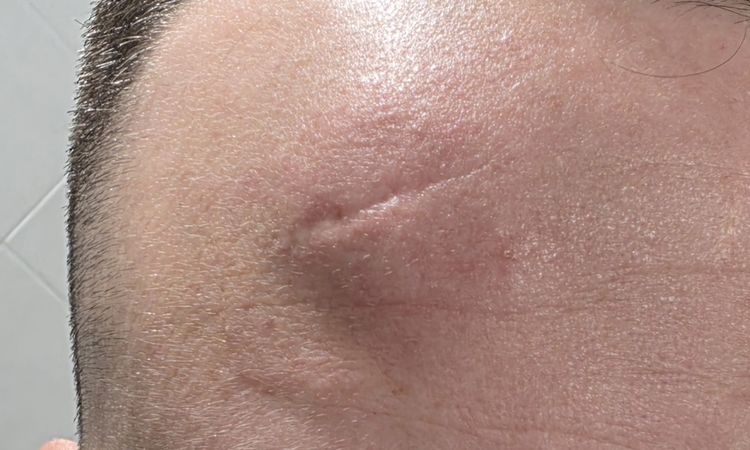 Gonfiore fronte post rimozione lipoma - 83181