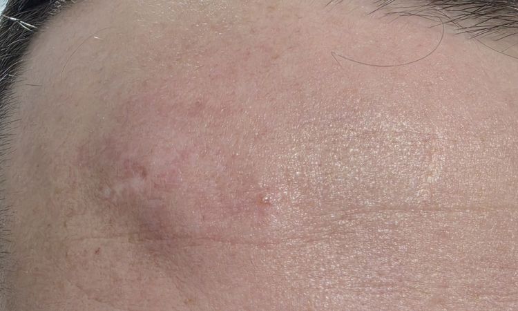 Gonfiore fronte post rimozione lipoma - 83182
