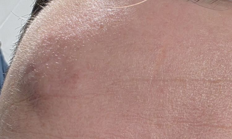 Gonfiore fronte post rimozione lipoma - 83183