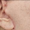 Laser cicatrici fresche