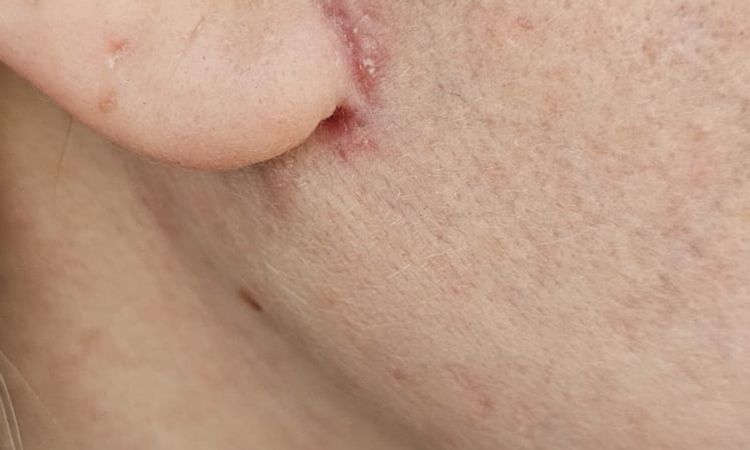 Laser cicatrici fresche - 83184