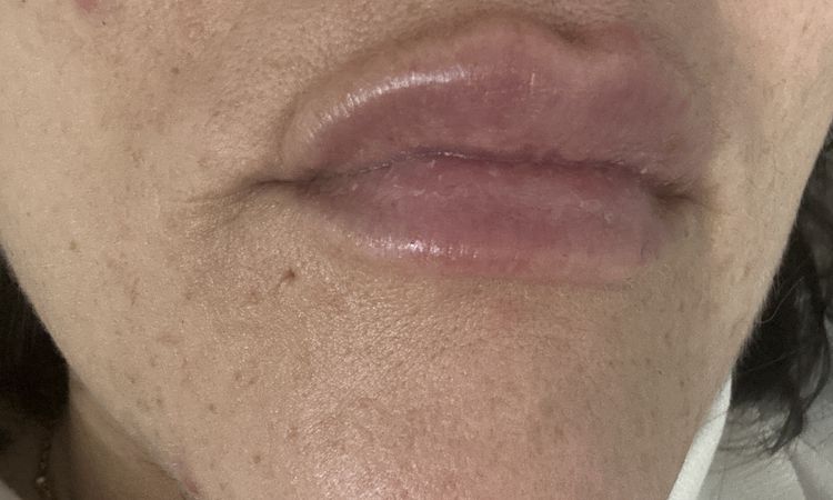 Filler labbra fatto da poco - 83236