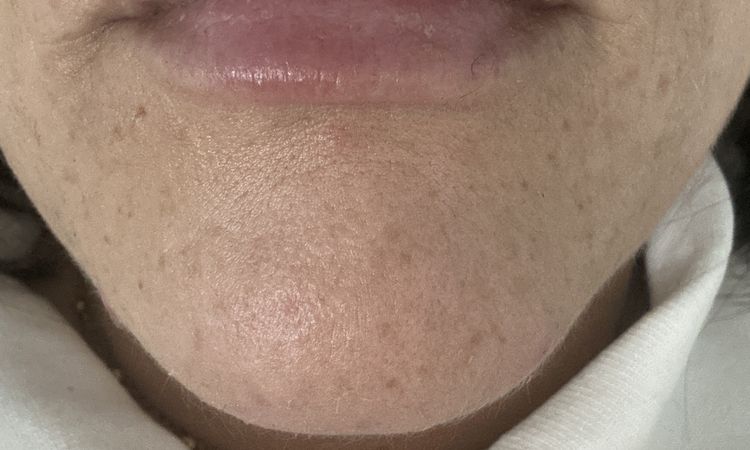 Filler labbra fatto da poco - 83237