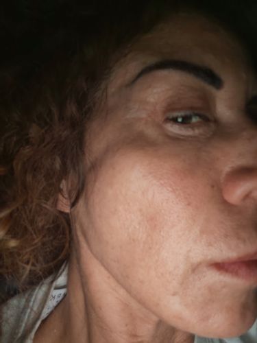 Trattamento con profhilo a distanza di 10 ore
