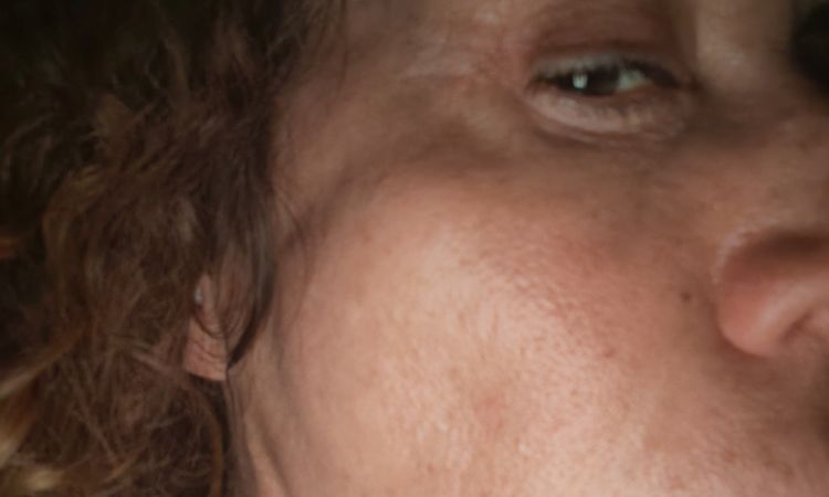 Trattamento con profhilo a distanza di 10 ore - 83241