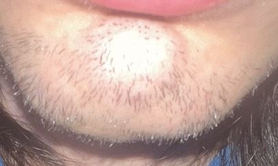 Gonfiore al mento ed epilazione laser - 83288