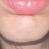 Gonfiore al mento ed epilazione laser