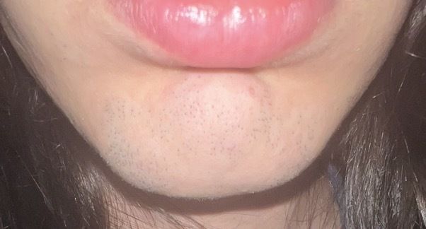 Gonfiore al mento ed epilazione laser - 83289