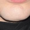 Gonfiore al mento ed epilazione laser