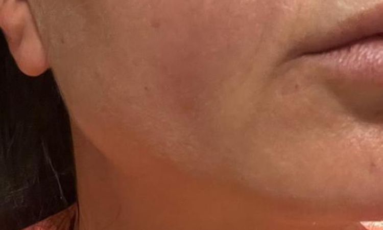 Complicazione da filler - 83364