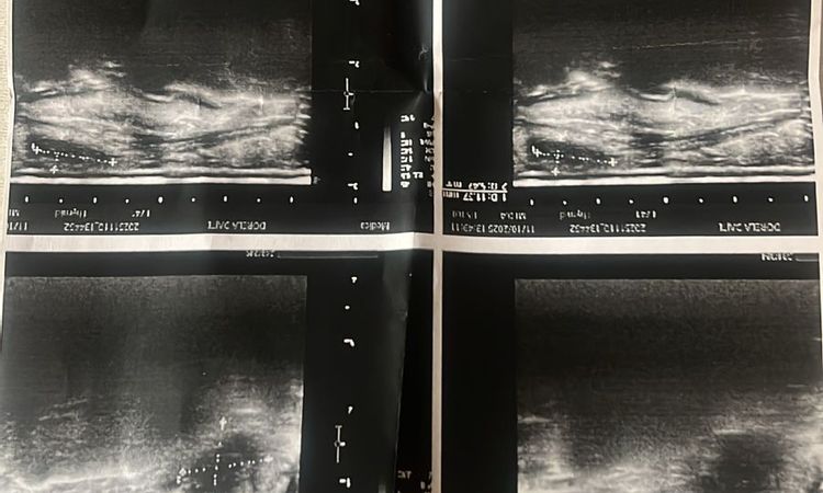 Complicazione da filler - 83365