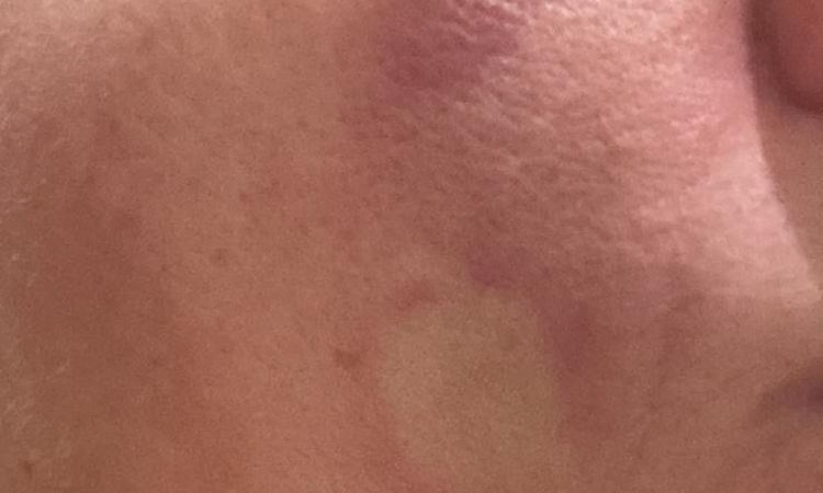 Complicazione da filler - 83366