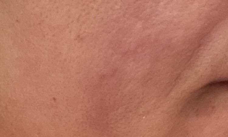 Complicazione da filler - 83367