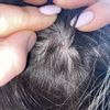 Asportazione fibroma dal cuoio capelluto con laser