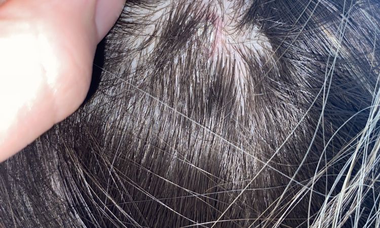 Asportazione fibroma dal cuoio capelluto con laser - 83373