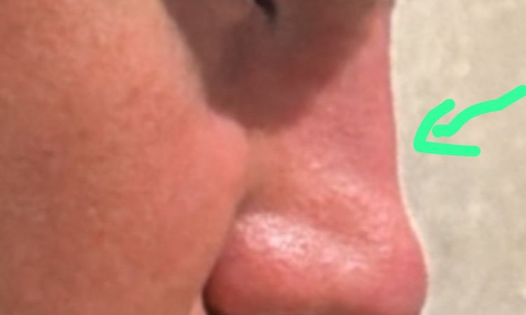 Rinofiller eseguito ieri - 83457