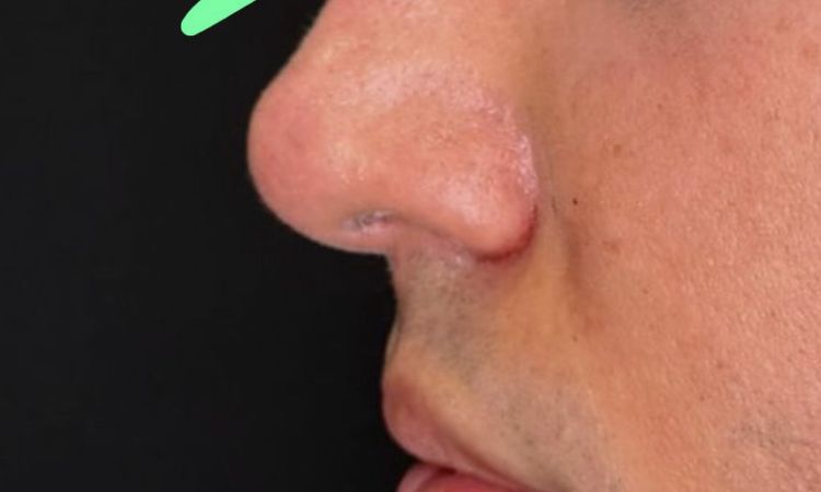 Rinofiller eseguito ieri - 83458