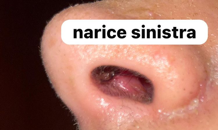 Infezione a seguito di rinoplastica - 83459