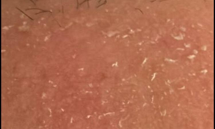 Dermatite post trapianto capelli con tecnica dhi - 83463