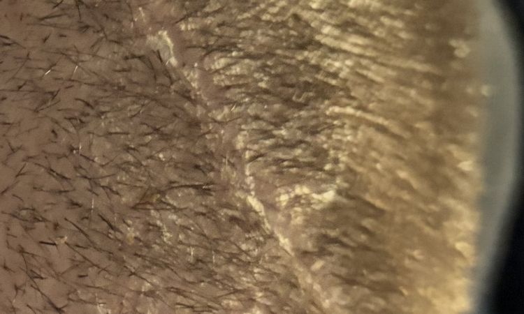 Dermatite post trapianto capelli con tecnica dhi - 83464