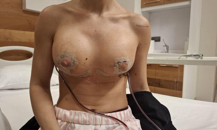 Mastopessi con protesi 280cc - 83467