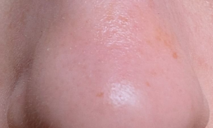 Rinofiller dopo 1 anno - 83469