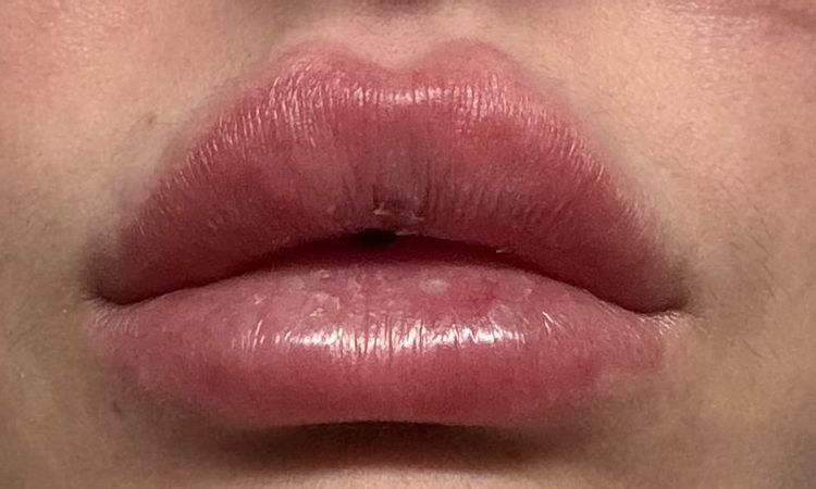 Livido dopo un mese dal filler labbra - 83501