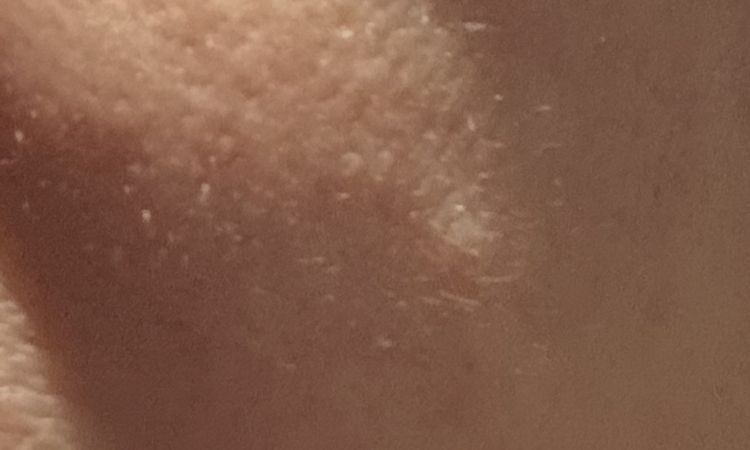 Calo palpebre post dimagrimento - 83511