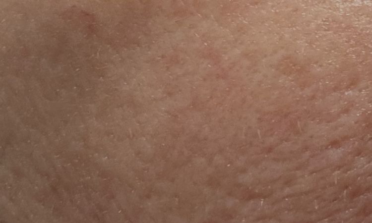 Calo palpebre post dimagrimento - 83512