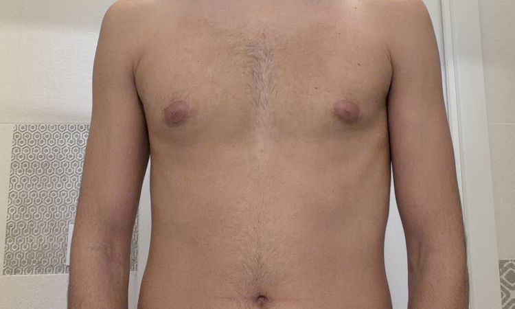 Ginecomastia post intervento 2 mesi - 83522