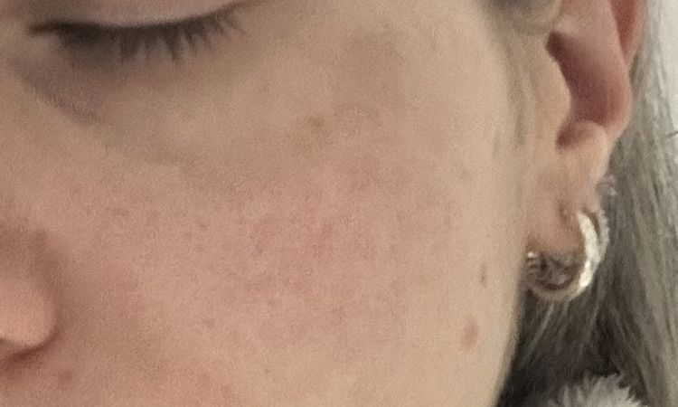 Eritema laser frazionato dopo più di 3 mesi - 83534