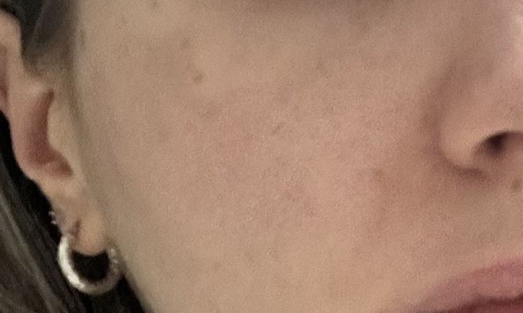 Eritema laser frazionato dopo più di 3 mesi - 83535