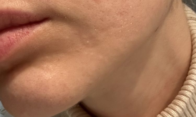 Eritema laser frazionato dopo più di 3 mesi - 83536