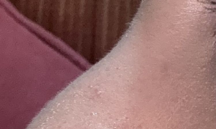 Rinoplastica dopo 37 giorni, gobba o edema? - 83541