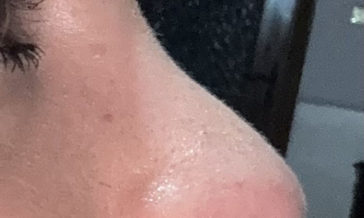 Rinoplastica dopo 37 giorni, gobba o edema? - 83542